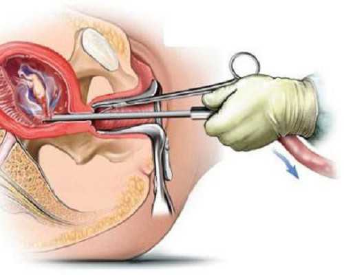 权威助孕机构,做滁州助孕供卵代怀婴儿详细过程是什么的